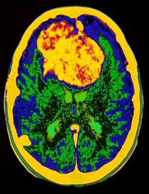 опухоль мозга в цвете