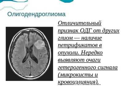 олигодендроглиома с наличием петрификатов