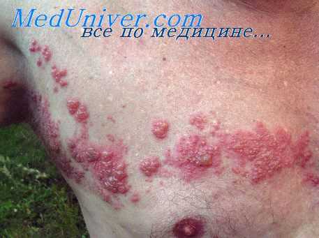 опоясывающий герпес