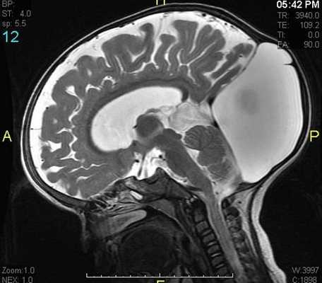 КТ при травме черепа