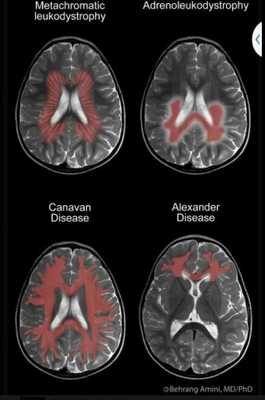 КТ энцефалопатий