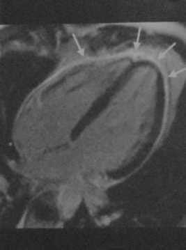 Снимки МРТ и КТ. Острый перикардит