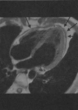 Снимки МРТ и КТ. Острый перикардит