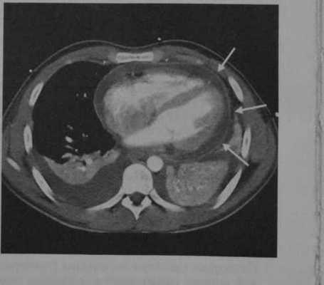 Снимки МРТ и КТ. Острый перикардит