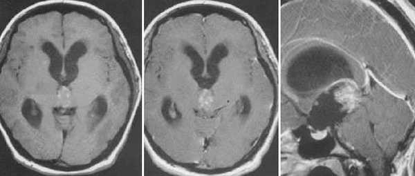  МРТ в диагностике патологий шишковидной железы 
