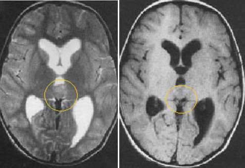  МРТ в диагностике патологий шишковидной железы 
