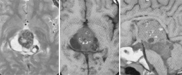  МРТ в диагностике патологий шишковидной железы 
