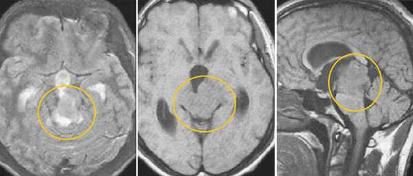  МРТ в диагностике патологий шишковидной железы 