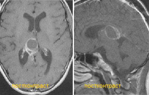  МРТ в диагностике патологий шишковидной железы 