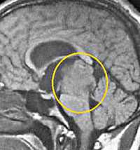 Опухоль эпифиза