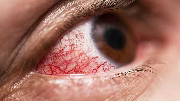 Эписклерит