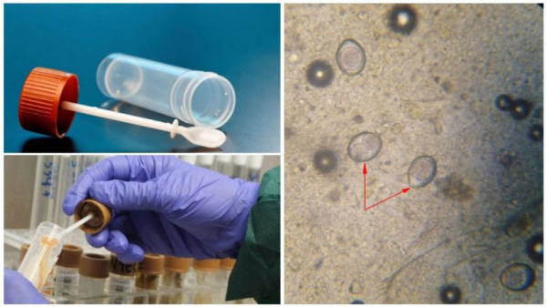 Трихоцефалёз