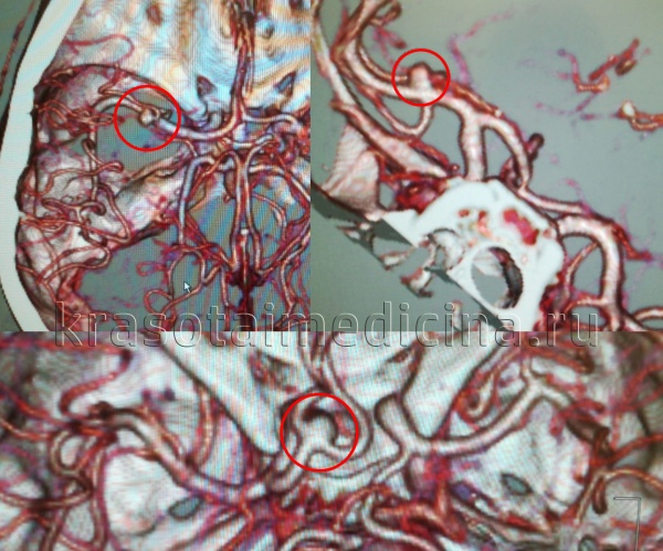 Аневризмы сосудов головного мозга