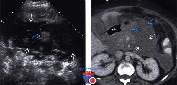 УЗИ, КТ при остром панкреатите
