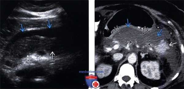 УЗИ, КТ при остром панкреатите