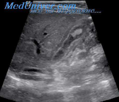 острый панкреатит