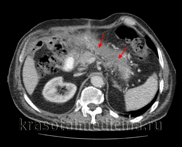 КТ ОБП. Панкреонекроз. Диффузный отек и нарушение структуры поджелудочной железы, отсутствие накопления контраста в ее паренхиме.