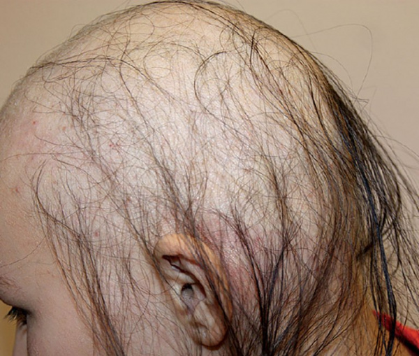 Алопеция при отравлении таллием