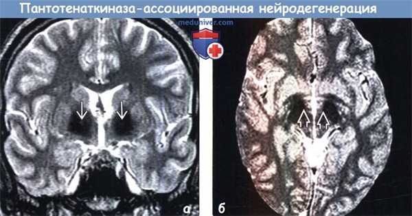 Пантотенаткиназа-ассоциированная нейродегенерация (ПКАН) на МРТ