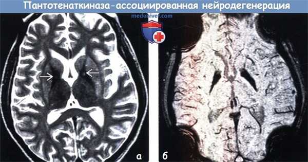 Пантотенаткиназа-ассоциированная нейродегенерация (ПКАН) на МРТ