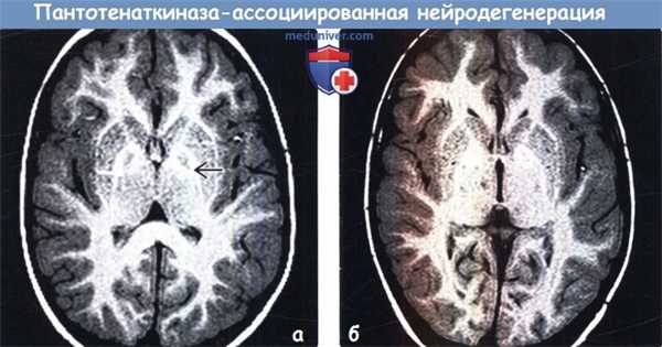 Пантотенаткиназа-ассоциированная нейродегенерация (ПКАН) на МРТ