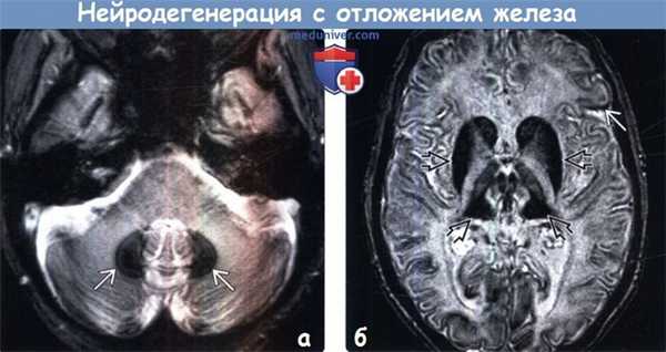 Нейродегенерация с отложением железа в головном мозге на МРТ