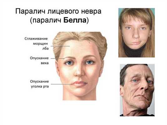 Паралич лицевого нерва