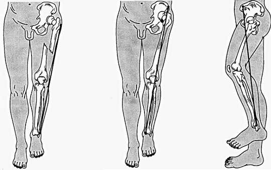 Деформация и нарушение функции конечности