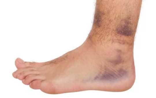 Подкожное кровоизлияние