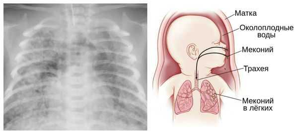 Мекониальная аспирация