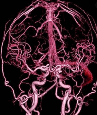 КТ-ангиография сосудов головы