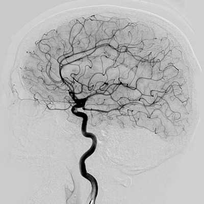 Классическая ангиография фото