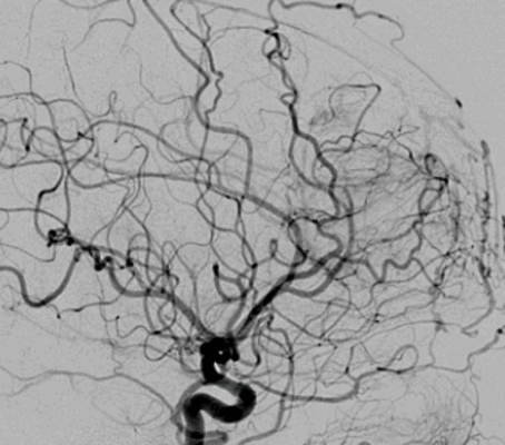Ангиография сосудов головы