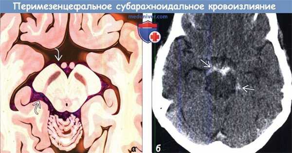 Перимезенцефальное субарахноидальное кровоизлияние (пнСАК) на КТ