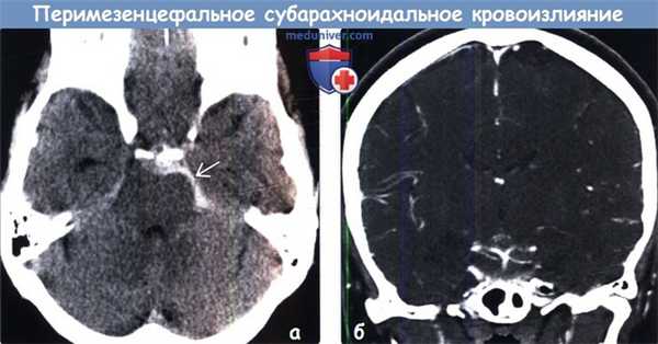 Перимезенцефальное субарахноидальное кровоизлияние (пнСАК) на КТ