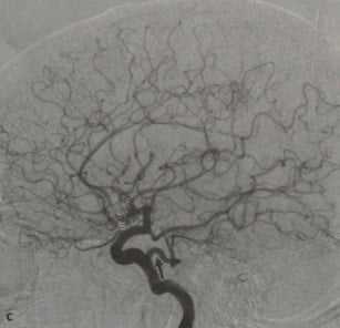 Снимки МРТ и КТ. Персистирующая тригеминальная артерия