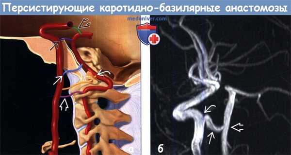 Персистирующие каротидно-базилярные анастомозы на МРТ, ангиограмме