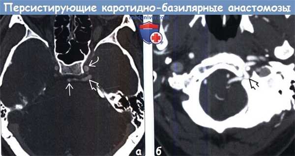Персистирующие каротидно-базилярные анастомозы на КТ, ангиограмме