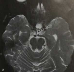 Снимки МРТ и КТ. Персистирующая тригеминальная артерия