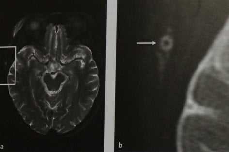 Снимки МРТ и КТ. Гигантоклеточный артериит 