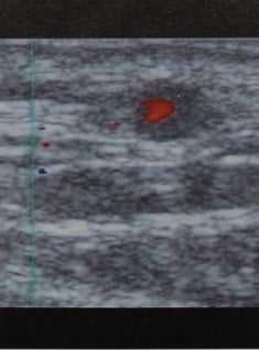 Снимки МРТ и КТ. Гигантоклеточный артериит 