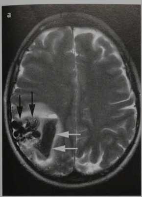 Снимки МРТ и КТ. Пиальная артериовенозная мальформация (ПАМ)