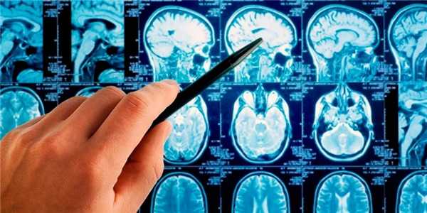 Астроцитома