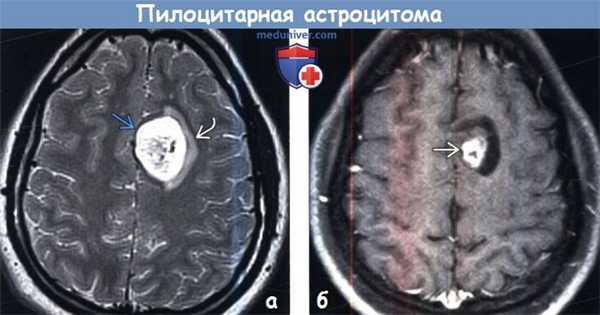 Пилоцитарная астроцитома на МРТ