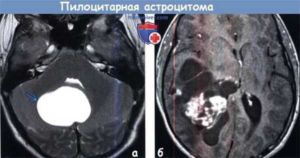 Пилоцитарная астроцитома на МРТ