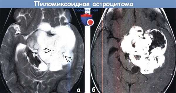 Пиломиксоидная астроцитома на МРТ