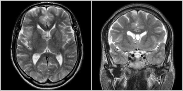 subependimarnaya-gigantokletochnaya-astrotsitoma-1