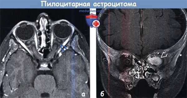 Пилоцитарная астроцитома на МРТ