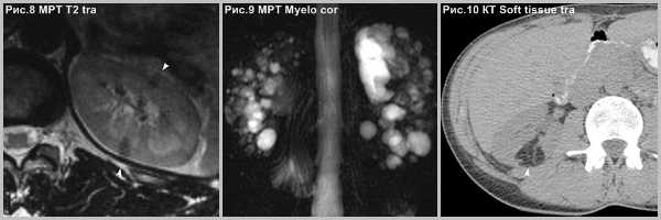 subependimarnaya-gigantokletochnaya-astrotsitoma-4