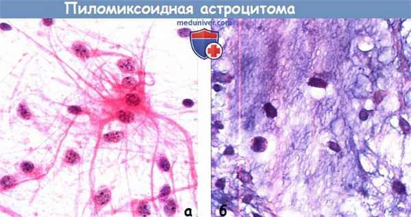 Пиломиксоидная астроцитома на МРТ